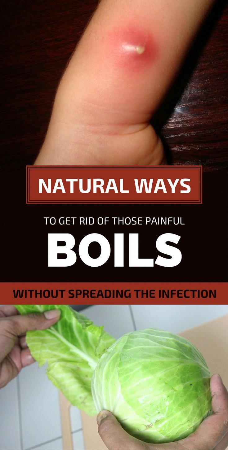 HOME REMEDIES TO GET RID OF BOIL