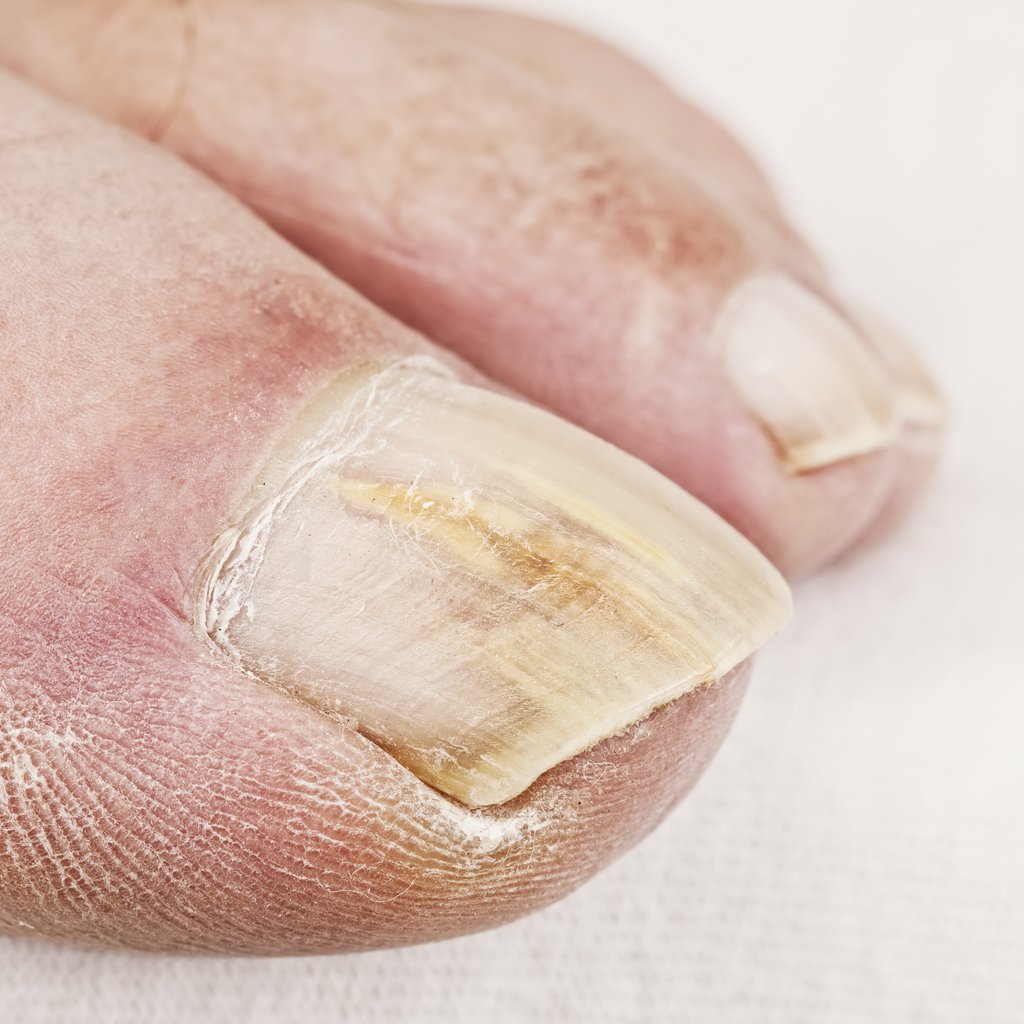 How can I prevent a fungal toenail infection?