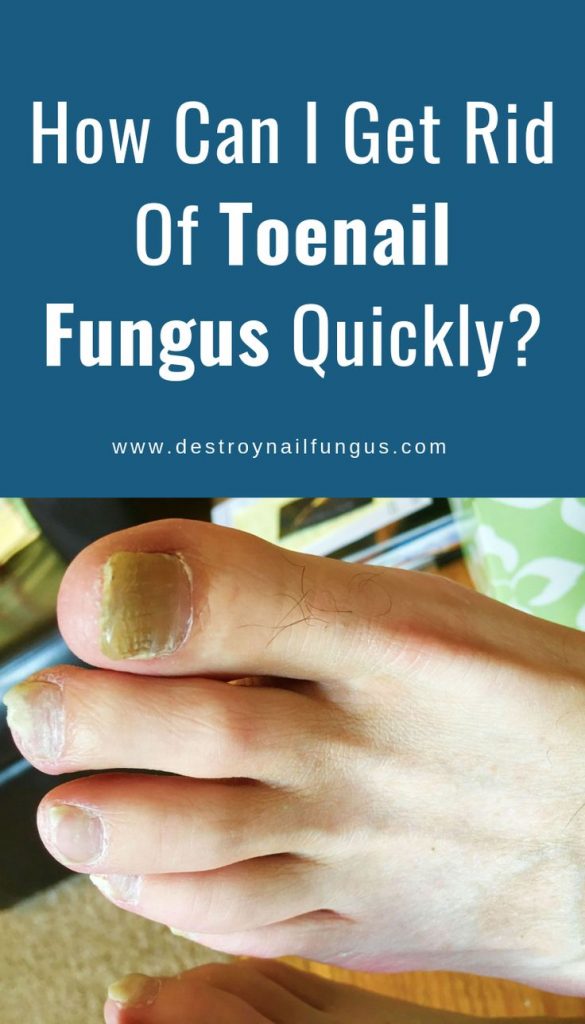 How Do I Get Rid Of Fungus On My Toenails