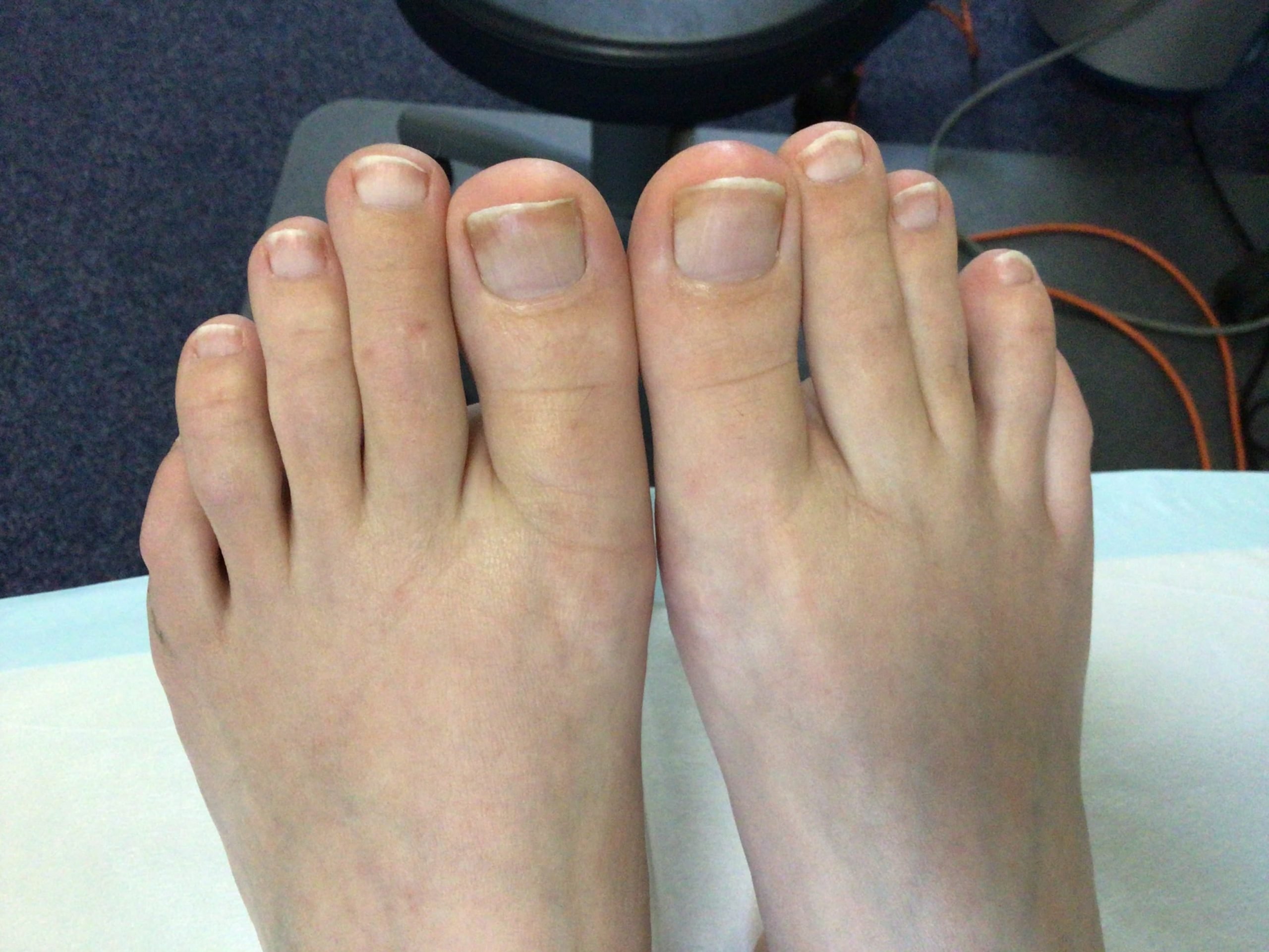 How do I get rid of my fungal nail infection?