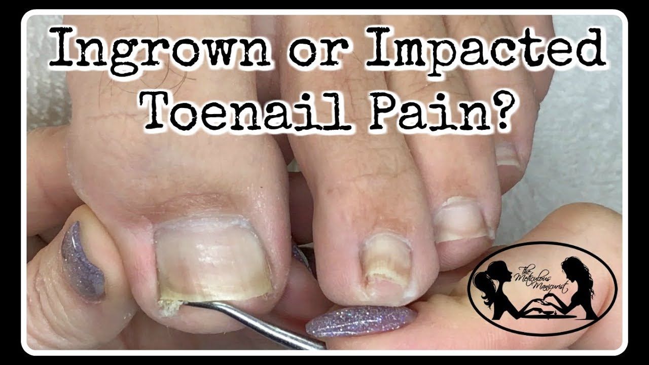 How Do I Permanently Get Rid Of An Ingrown Toenail