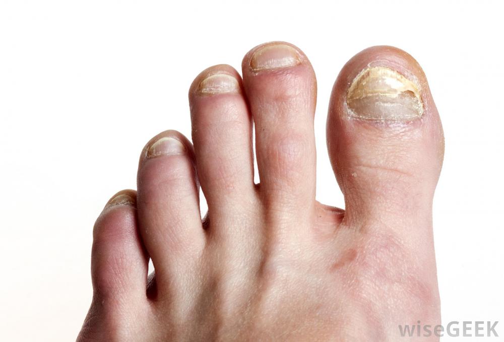 How do I Use Bleach for Toenail Fungus? (with pictures)