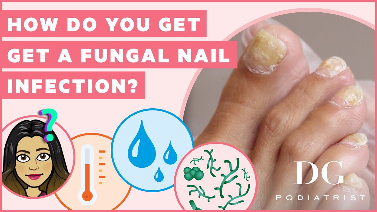 How do you get a fungal nail infection?