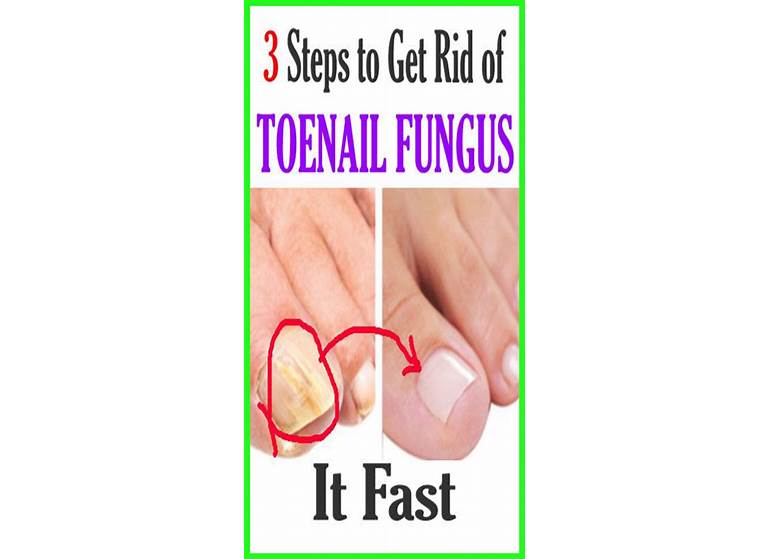 How Do You Get Rid Of Toenail Fungus Permanently