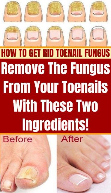 How Do You Remove Gel Polish From Your Toenails