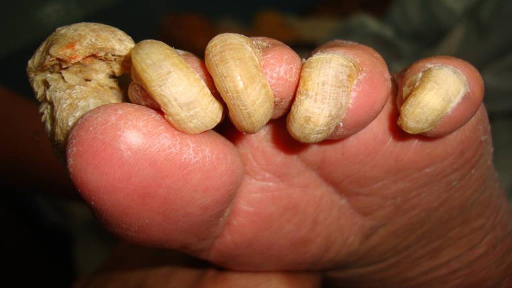 How Does Nail Fungus Infection Develop And Get Deeper ...