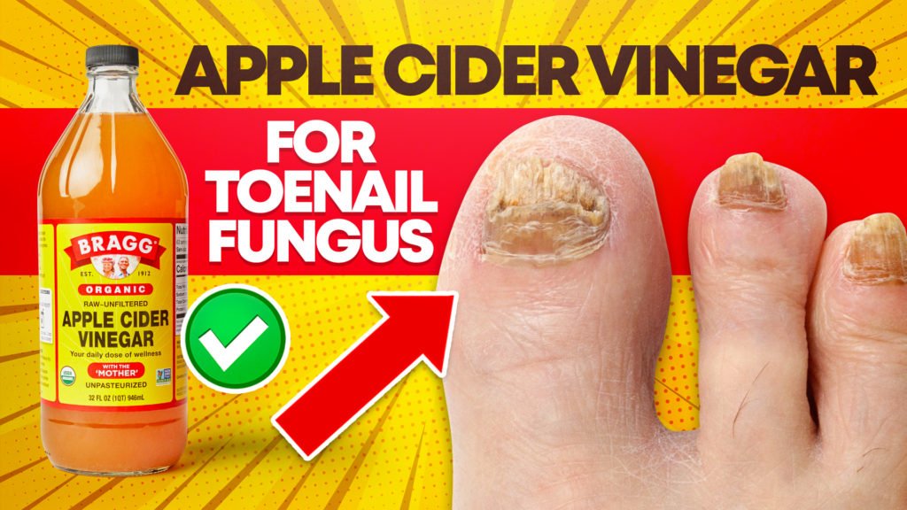 How Effective is Apple Cider Vinegar for Toenail Fungus ...