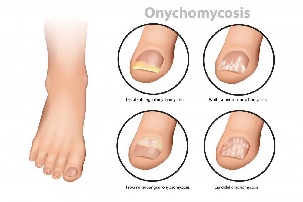 How Effective Is Laser Therapy for Toenail Fungus ...