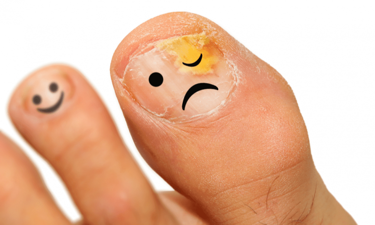 How Effective Is Laser Therapy for Toenail Fungus ...
