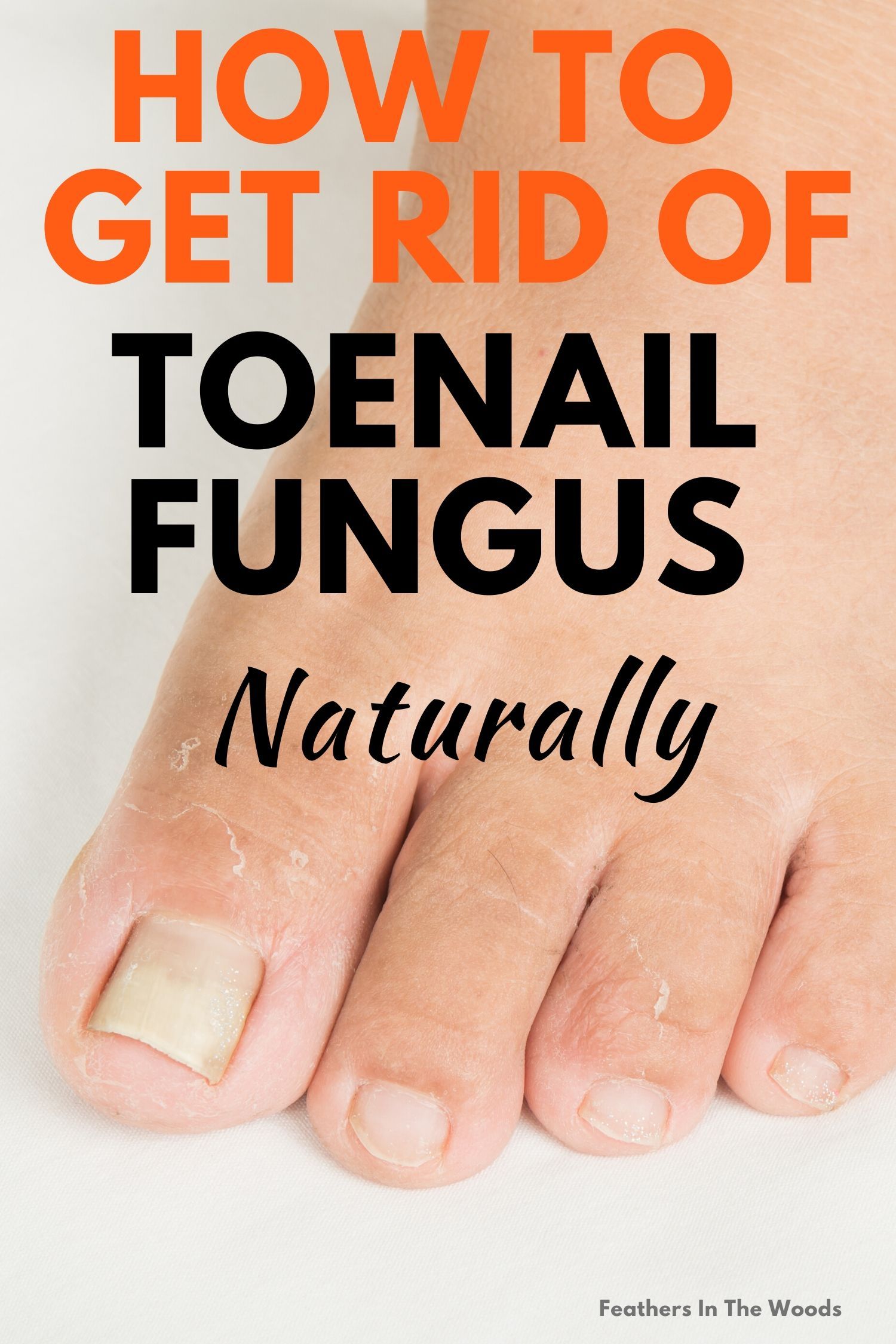 How I got rid of toenail fungus (quickly &  naturally) in 2020
