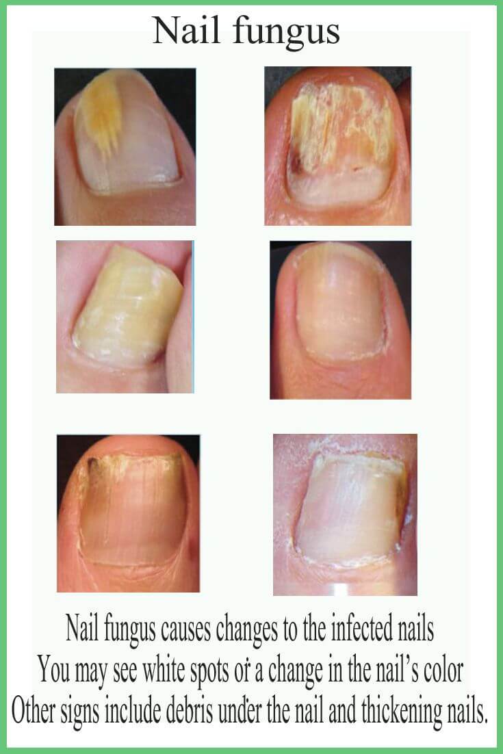 How Long Does It Take For A Toenail To Grow ?