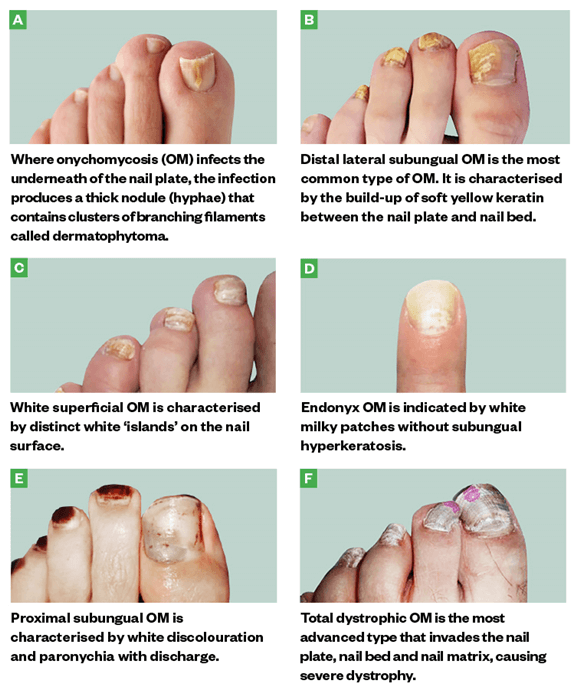 How Long Does It Take For A Toenail To Grow ?