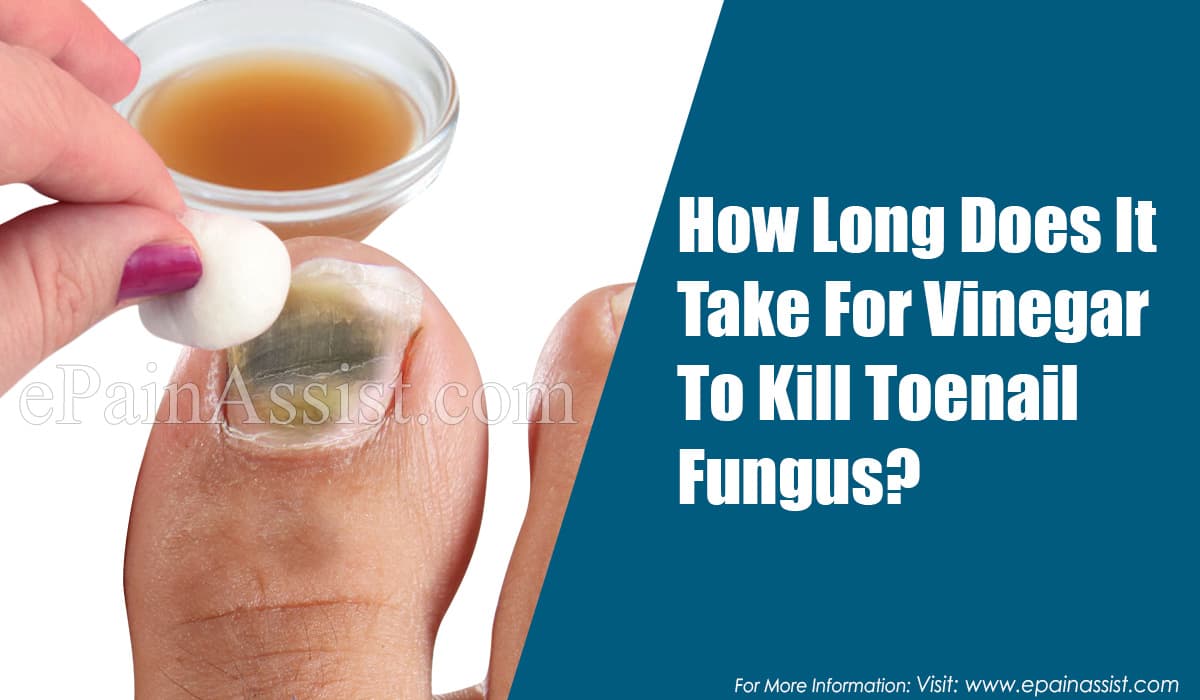 How Long Does It Take For Vinegar To Kill Toenail Fungus?