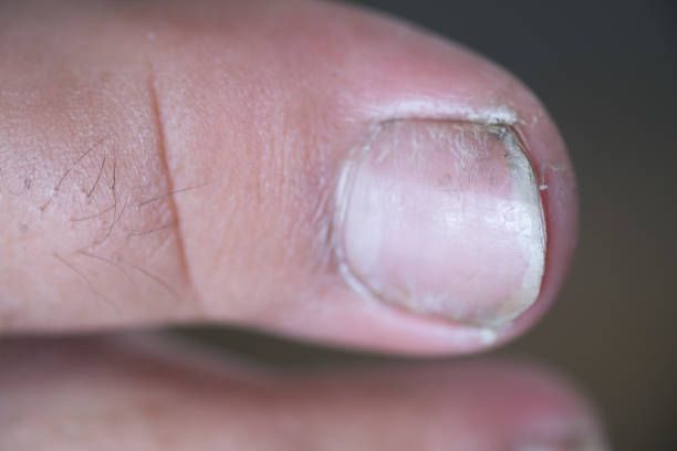 How Long Does It Take To Get Rid Of Nail Fungus With Tea ...
