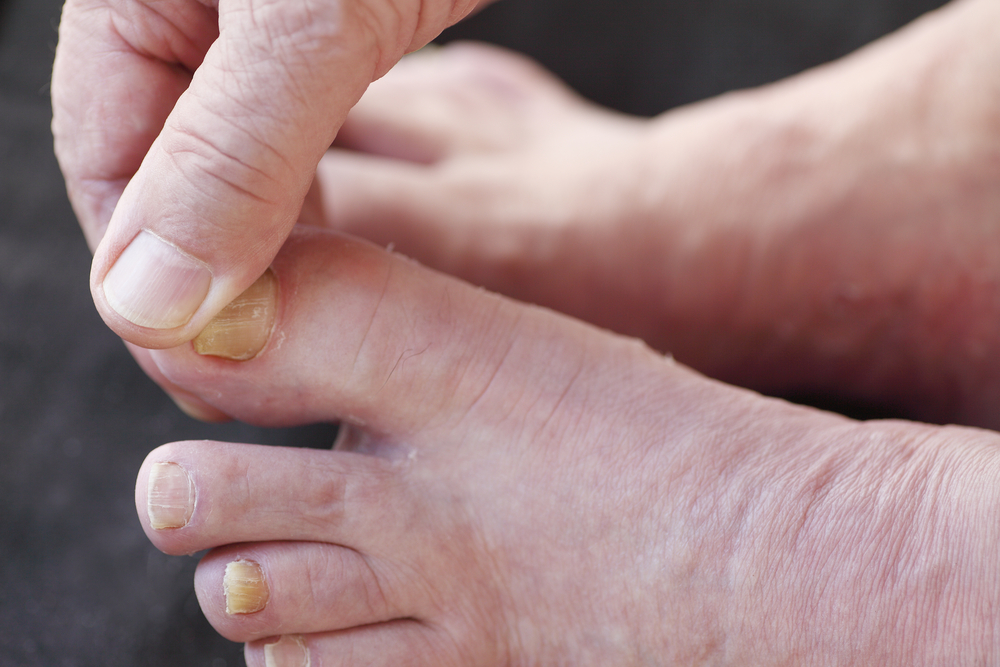 How Long Does It Take to Treat Fungal Toenails?
