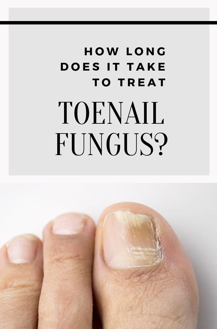How Long Does It Take To Treat Toenail Fungus?