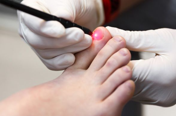 How Much Does Laser Therapy for Toenail Fungus Cost in ...