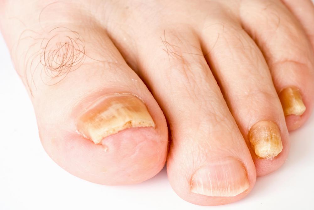 How Should I Treat Toenail Fungus? (with pictures)