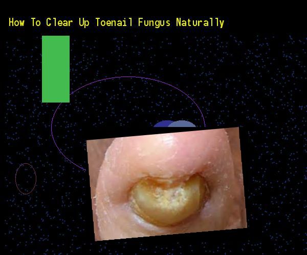 How to clear up toenail fungus naturally