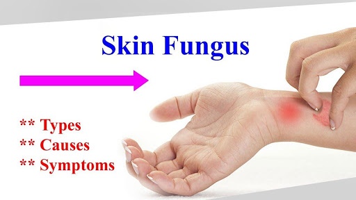 How to cure fungal infections with the help of food