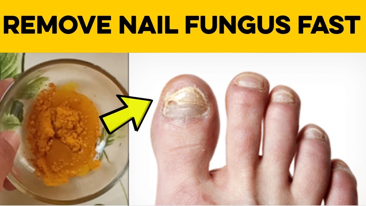 How to Cure Nail Fungus  2 Home Remedies for Toenail ...