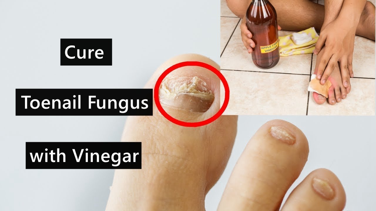 How to cure nail fungus fast
