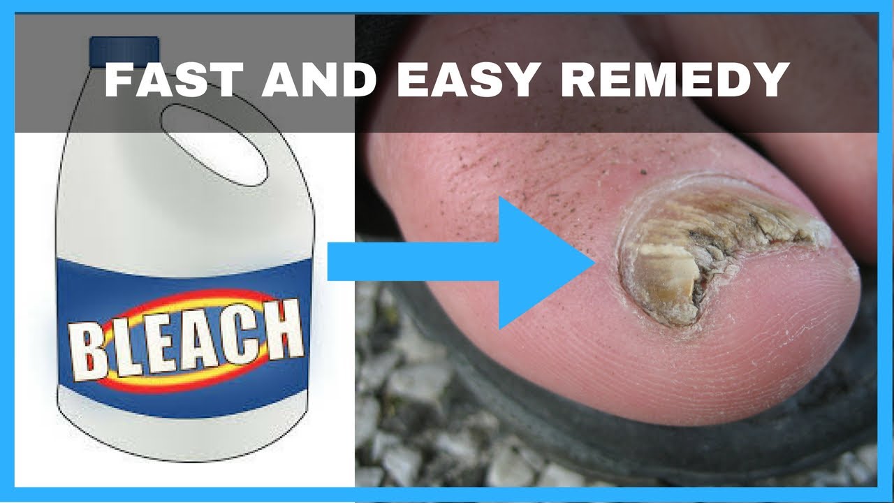 How To Cure Toenail Fungus At Home Fast