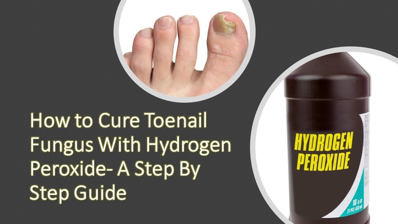 How to Cure Toenail Fungus With Hydrogen Peroxide