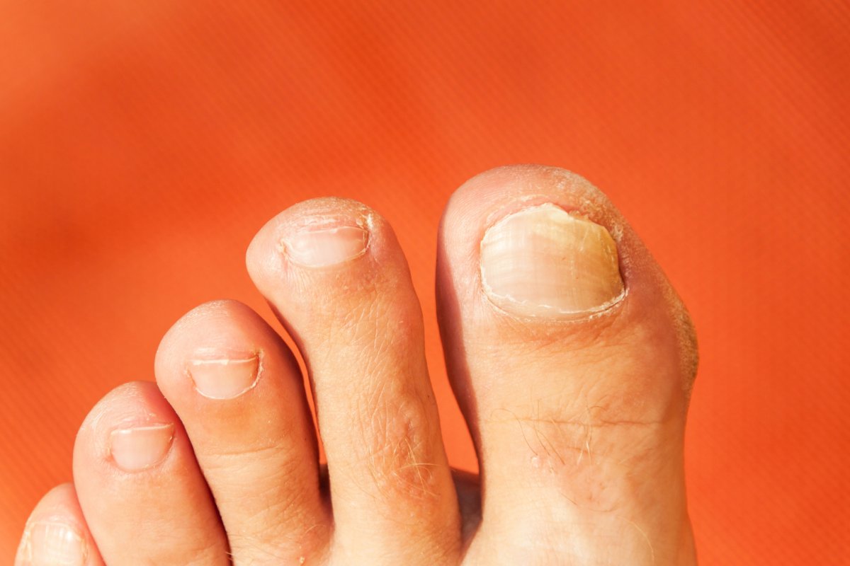 How to deal with toe fungus (and other common summer foot ...