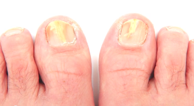 How to Detect the Early Signs of Toenail Fungus