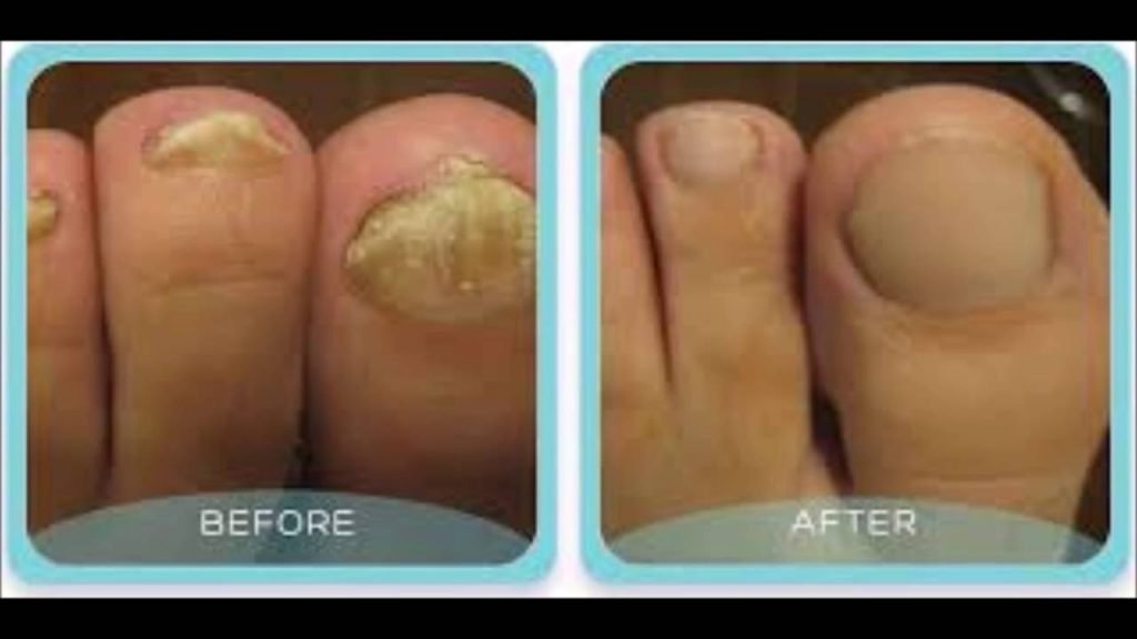 How To Disinfect Shoes From Toenail Fungus