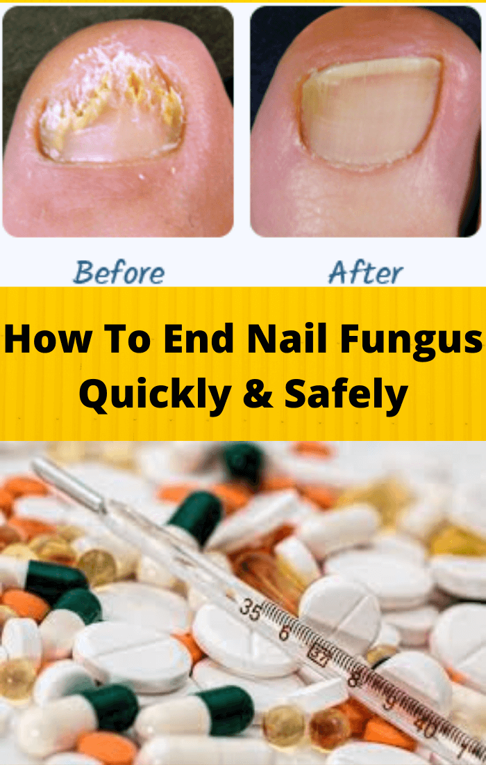 How To End Nail Fungus Effectively, Quickly And Safely