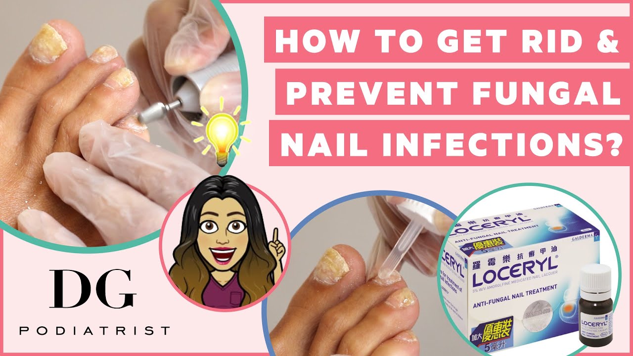 How to get rid and prevent toenail fungus?