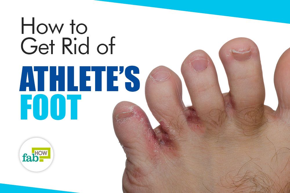 How to Get Rid of Athletes Foot Fast: Kill the Fungal Infection