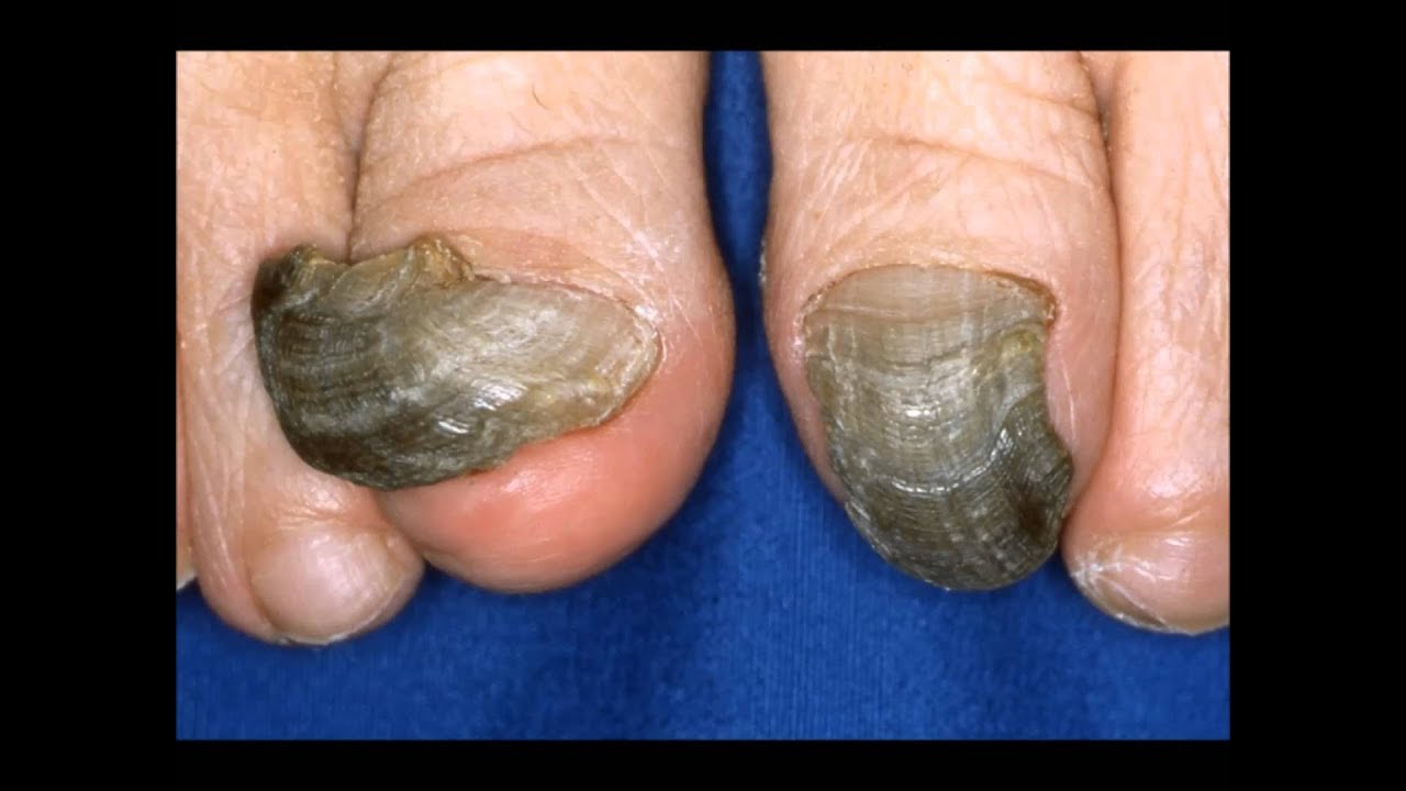 How to Get Rid of Black Toenail Fungus in Half the Time ...