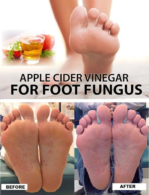 How To Get Rid Of Foot Fungus?