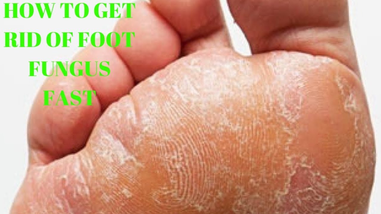 how to get rid of foot fungus fast