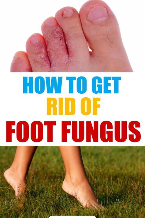 How to Get Rid of Foot Fungus  Home Remedies  Treatments