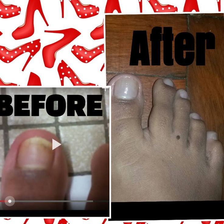 How To Get Rid Of Foot Fungus With Bleach Ideas