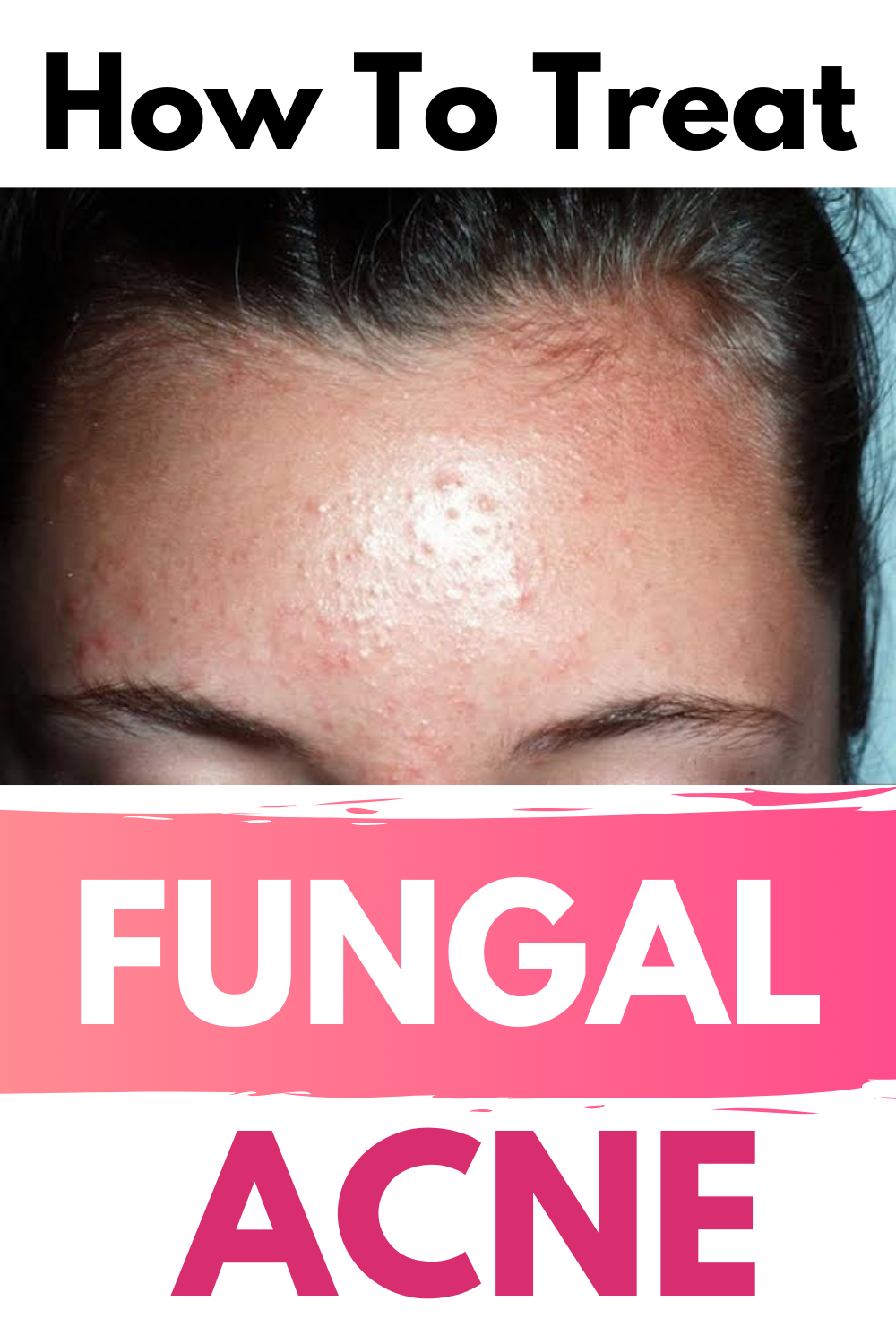 How To get rid of Fungal Acne in 2020