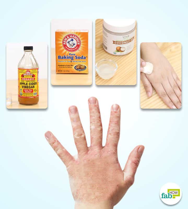 How to Get Rid of Fungal Infection (KILL the Fungus Naturally)