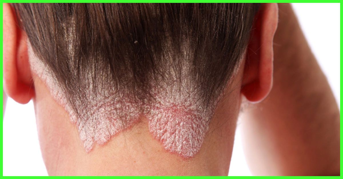 How To Get Rid Of Fungal Scalp Infection: 8 Natural ...