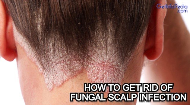 How To Get Rid Of Fungal Scalp Infection
