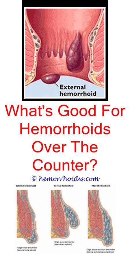 How To Get Rid Of Hemorrhoids Naturally At Home? what ...
