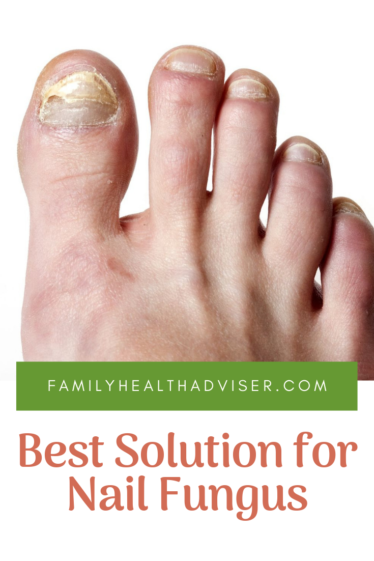 How to Get Rid of Nail Fungus Forever: Best Solution for ...