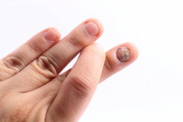 How To Get Rid Of Nail Fungus Under Artificial Nails ...