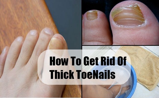 How To Get Rid Of Thick ToeNails