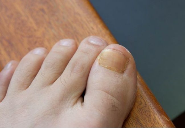 How To Get Rid Of Thick ToeNails