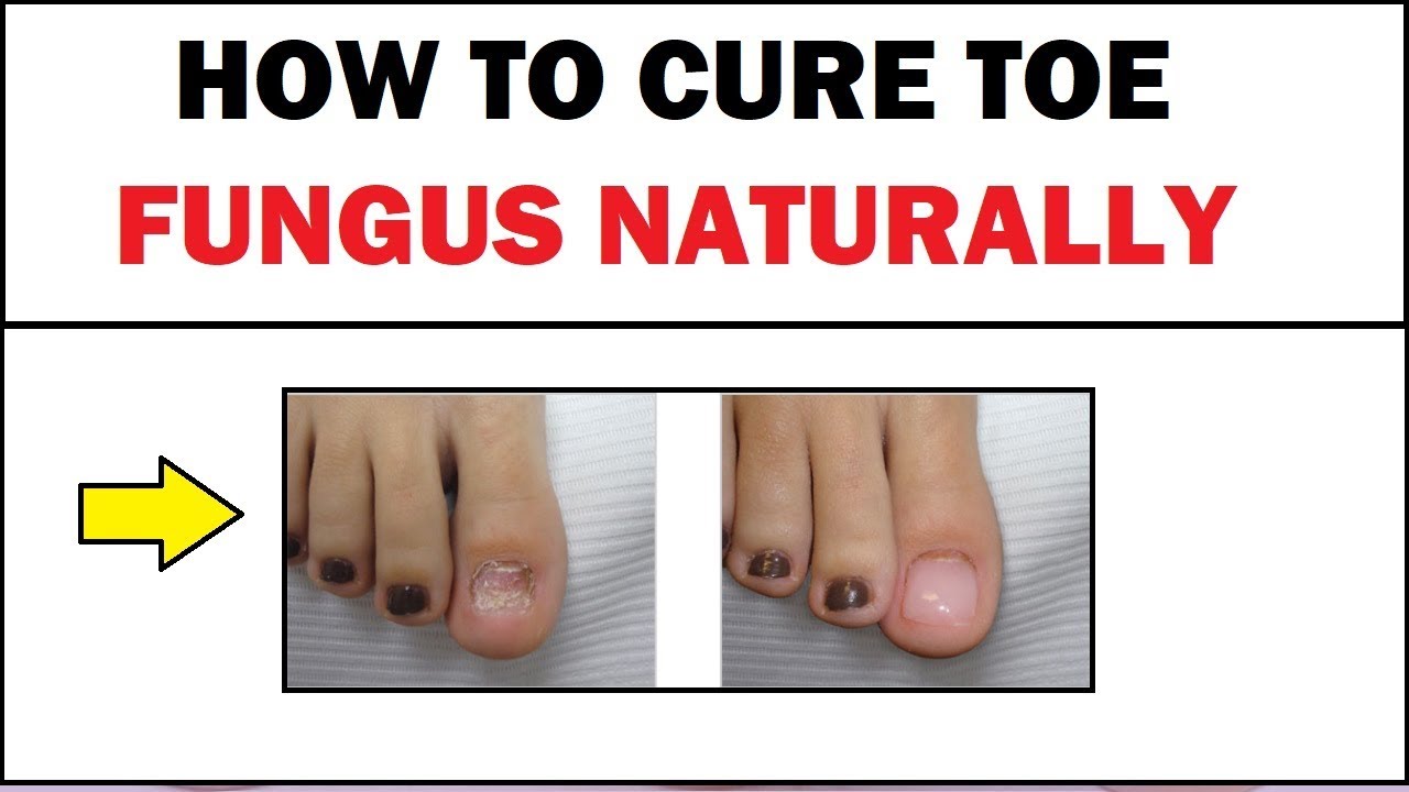 How To Get Rid Of Toe Fungus