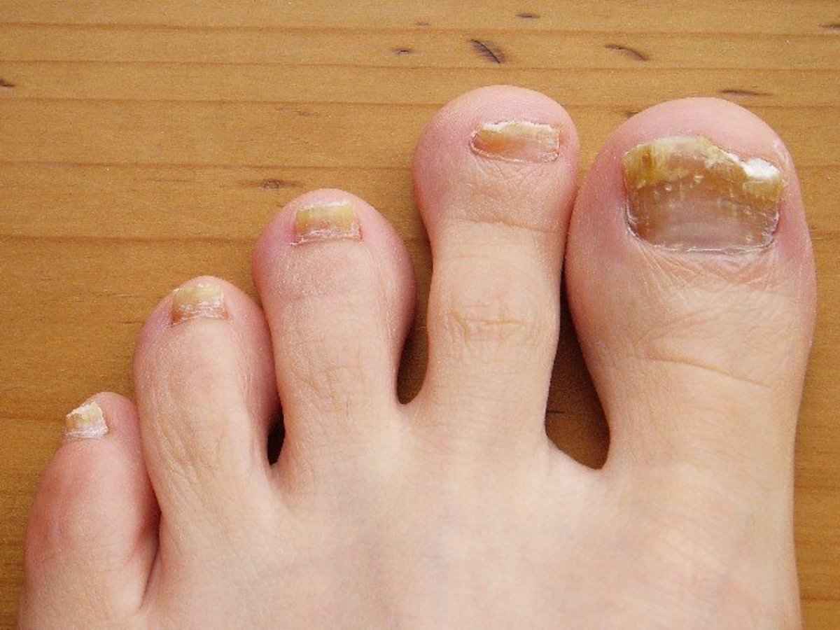 How to Get Rid of Toe Nail Fungus